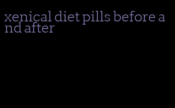 xenical diet pills before and after